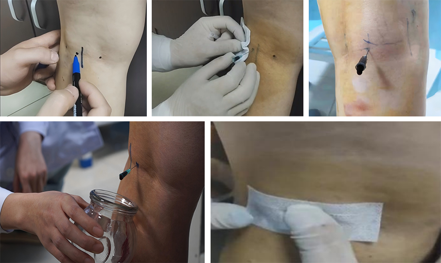 download?name=22.%E5%A7%94%E4%B8%AD%E7%A9%B4%E7%A9%BA%E9%92%88%E6%94%BE%E8%A1%80%E6%8A%80%E6%9C%AF++%E6%9D%8E%E7%BF%94.png&sig=1769151564%3A301fbd2c3181167fb0dee907ef06d5b477d7ced4b8924ab24cdfe4786fbe231c